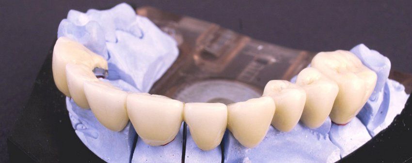 Implantologia dental en Manresa