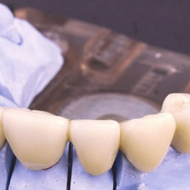 Implantologia dental en Manresa